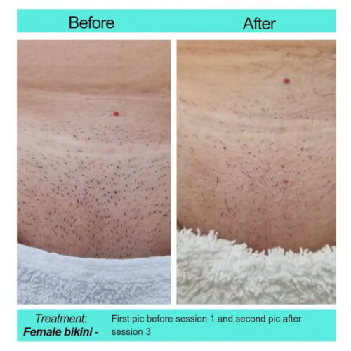 Before and After picture of female bikini